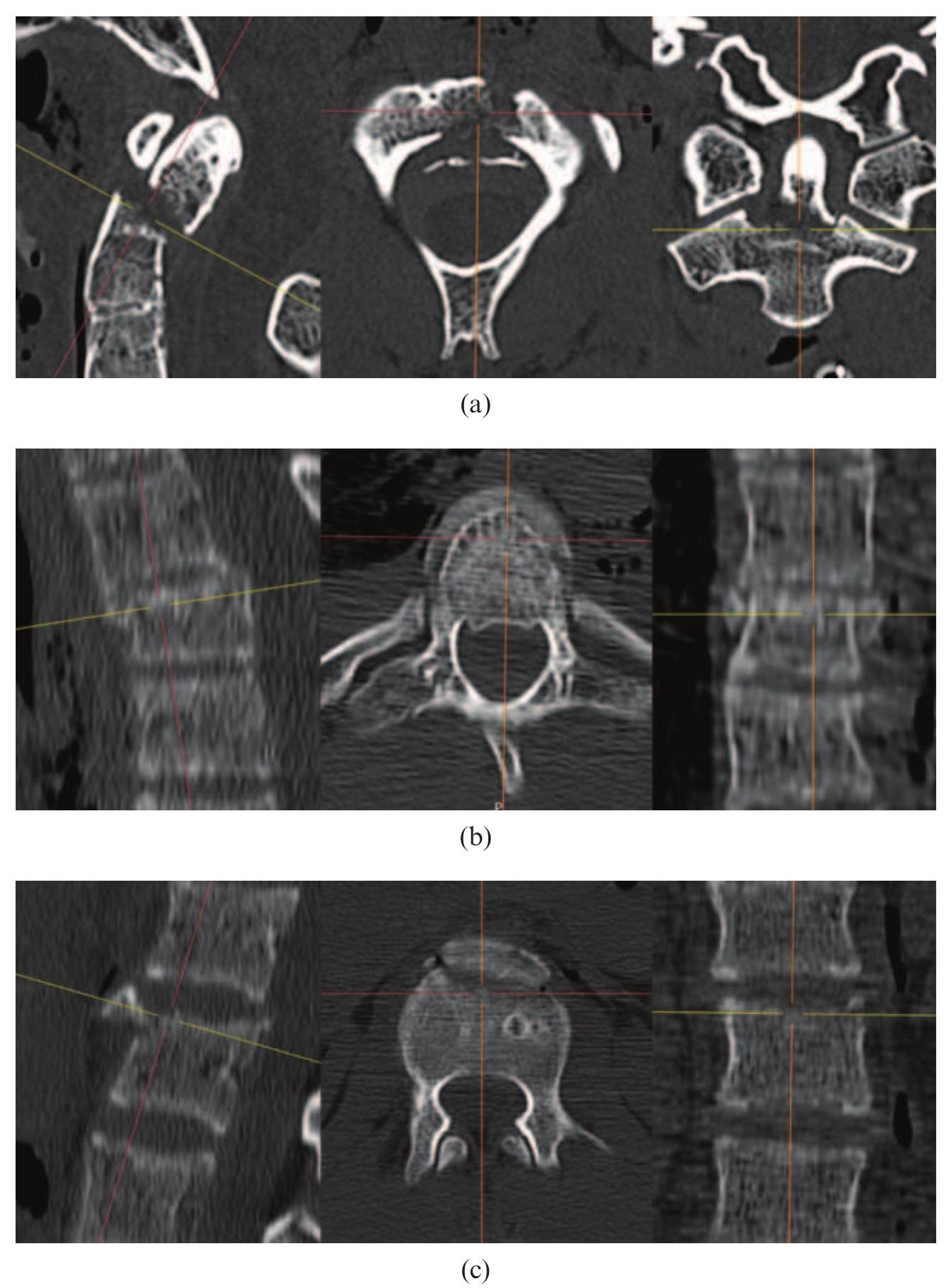 (PDF) Differentiation of ante-mortem and post-mortem fractures with MRI ...