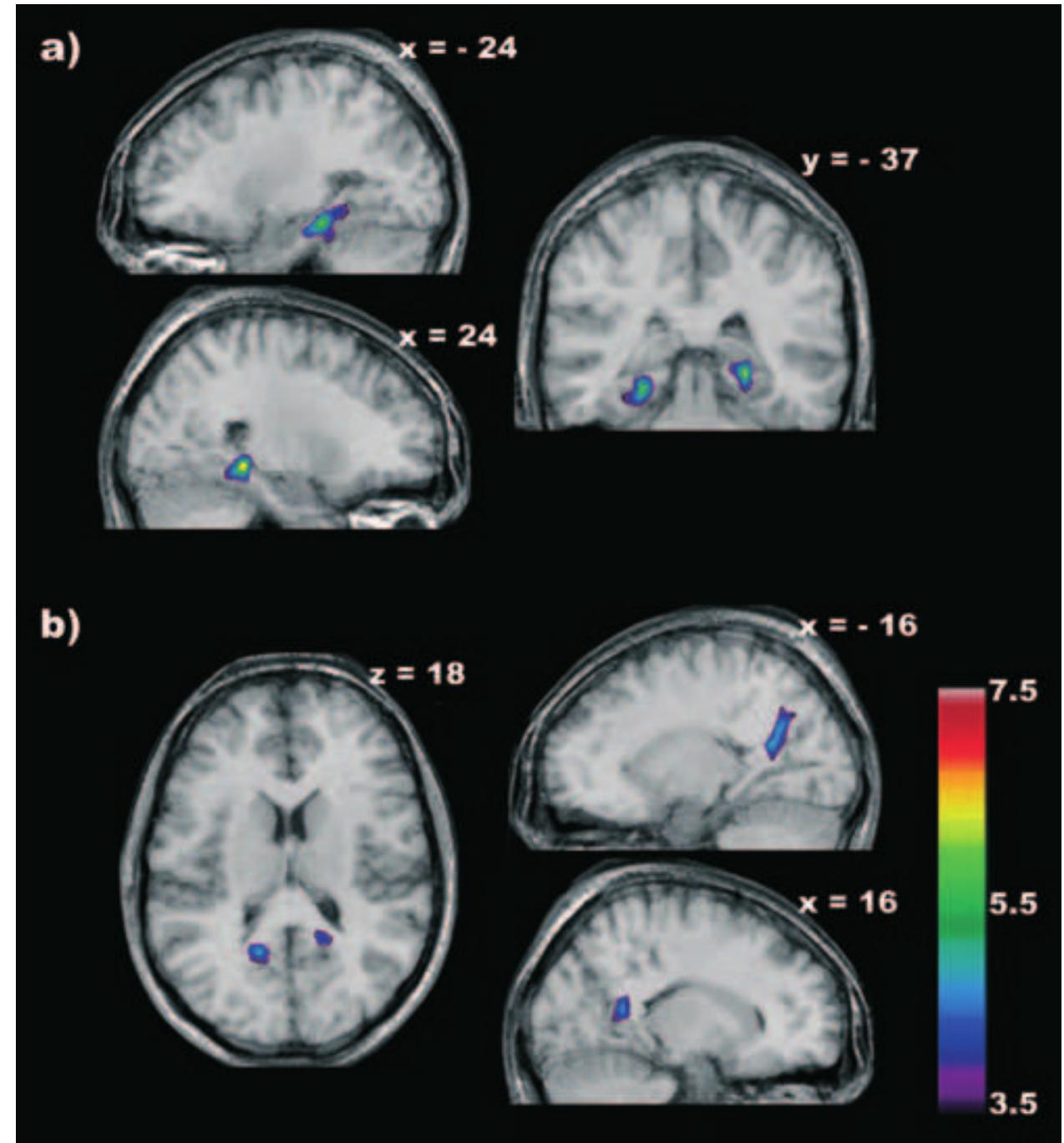 (PDF) Retrosplenial and hippocampal brain regions in human navigation ...