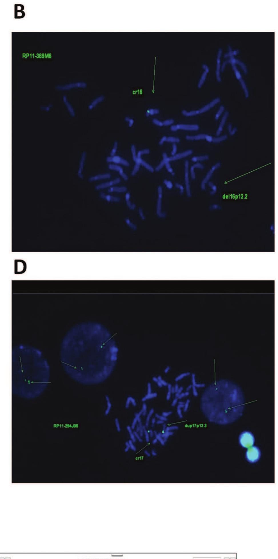 (PDF) New microdeletion and microduplication syndromes: a comprehensive ...
