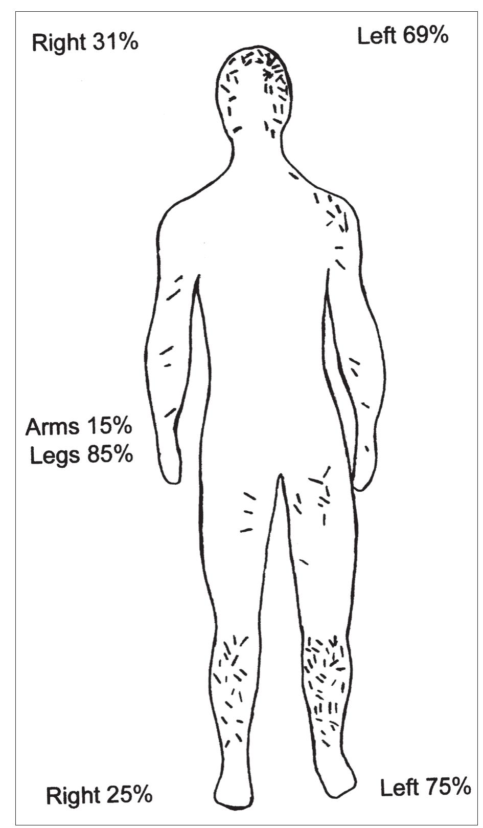 Figure 107. The distribution of sword or axe cuts on the men from Korsbetningen. Modified from Knowles 1983:fig. 9.  The reason that battle and war are discussed when the above-mentioned graves are analysed depends among other things on signs of weapon related trauma on the keletons. When signs of trauma on a bone are ob- erved, the side, the location on the skeletal element, the degree of damage and morphologic appearances are noted. It is also important to understand if the skeletal wounds originate antemortem, perimortem or postmortem. Wounds made antemortem show signs  S. Ss  