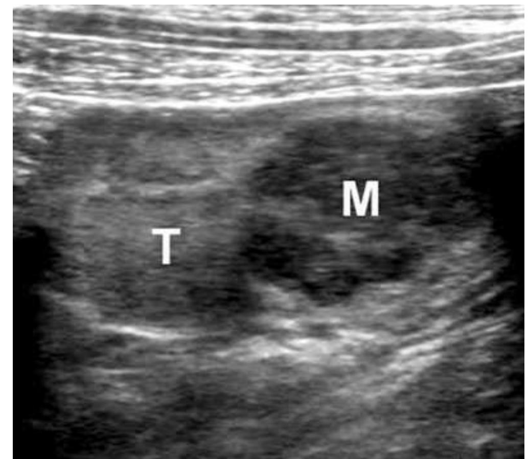 Fic. 4. sagittal ultrasound image of an abdominally retained
