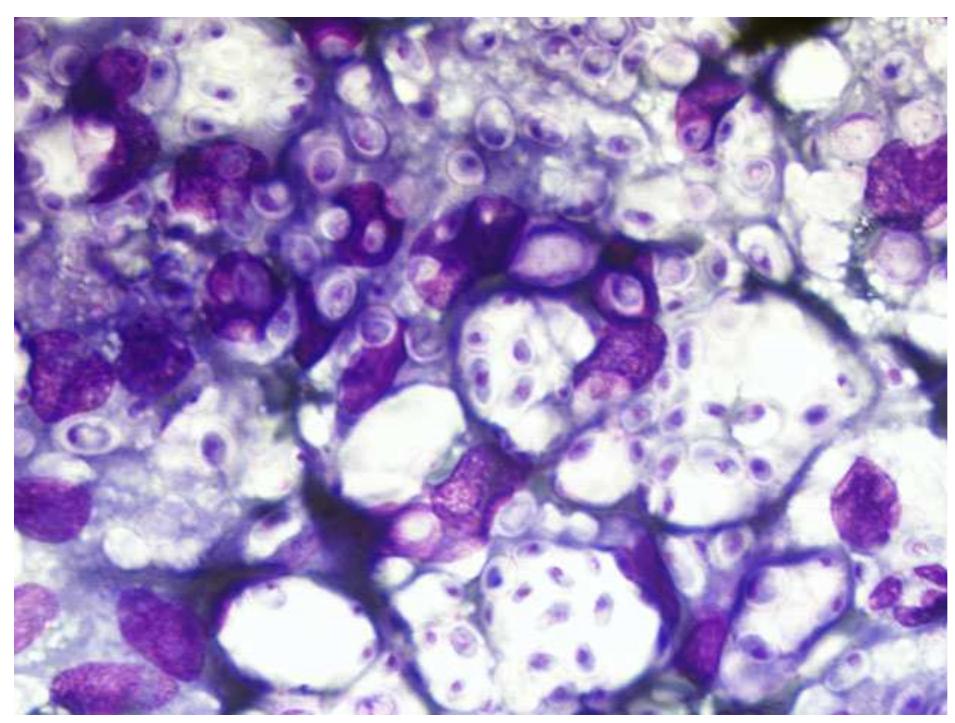 Cryptococcus neoformans var. grubii seen in the pyogenic