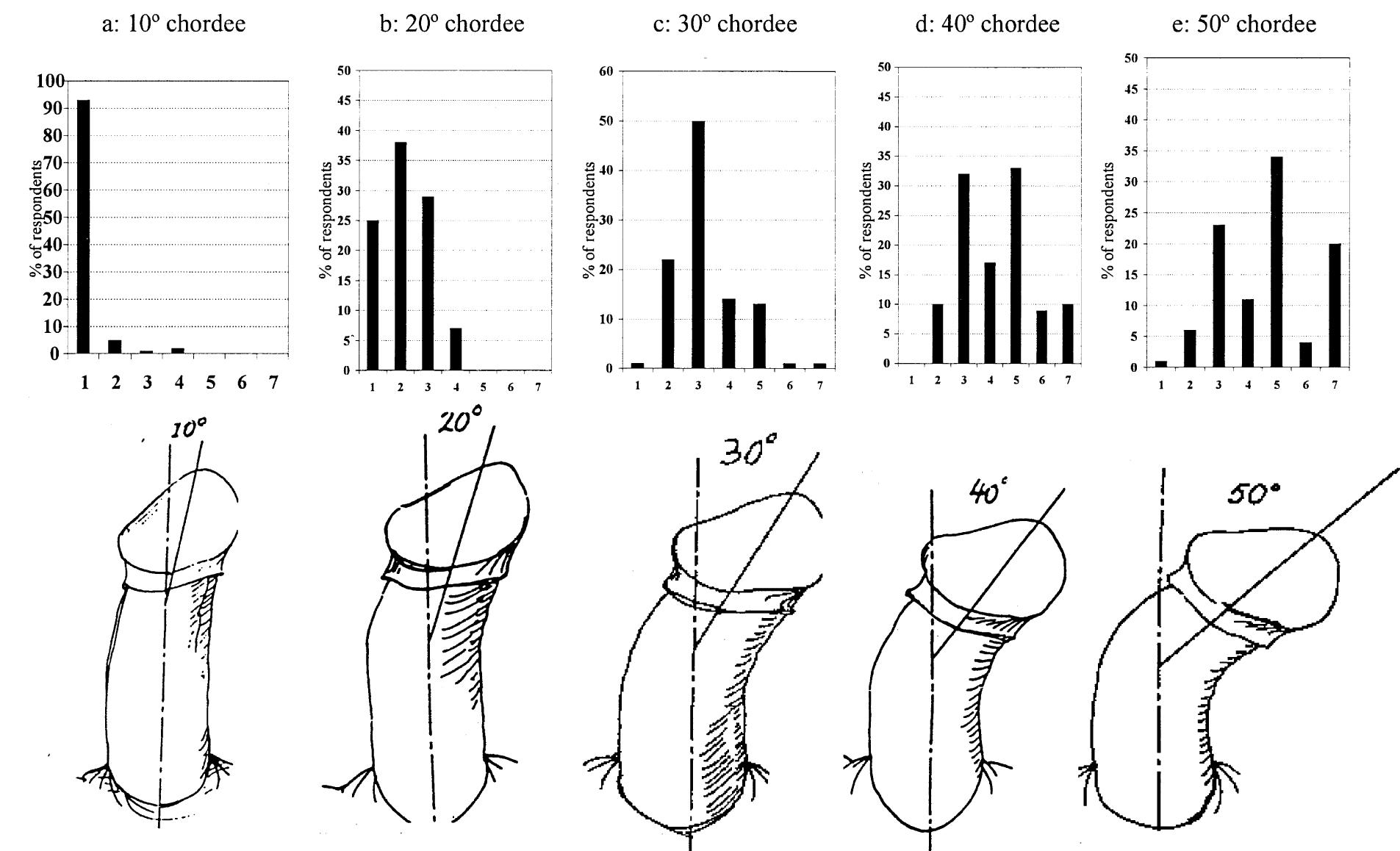 HYPOSPADIAS AND EPISPADIAS - pediagenosis, image size:1905x1158