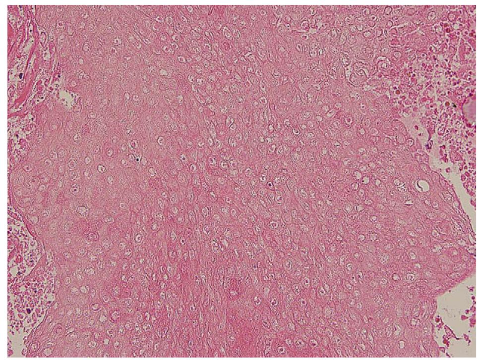 Shadow Cell (PDF) Eyelid Pilomatrixoma: A Description of 16 cases and a Review of ...