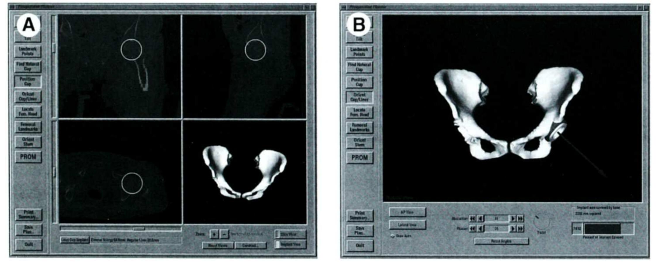 Figure 1 - from Surgical navigation for total hip