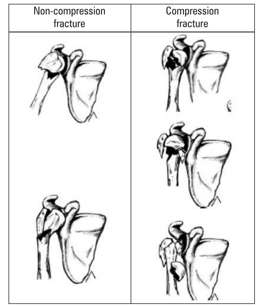 Lesser Compression Neer classification (1970) for fractures of proximal humerus