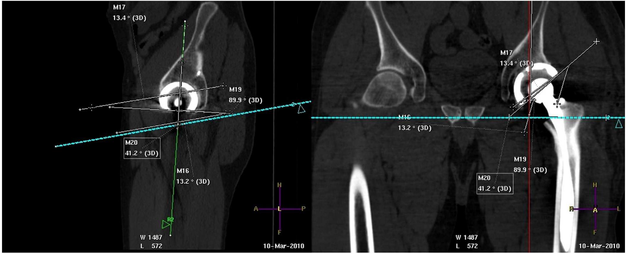 Perpendicular Inclination Tomographic anterior pelvic plane (app), assumed to be the