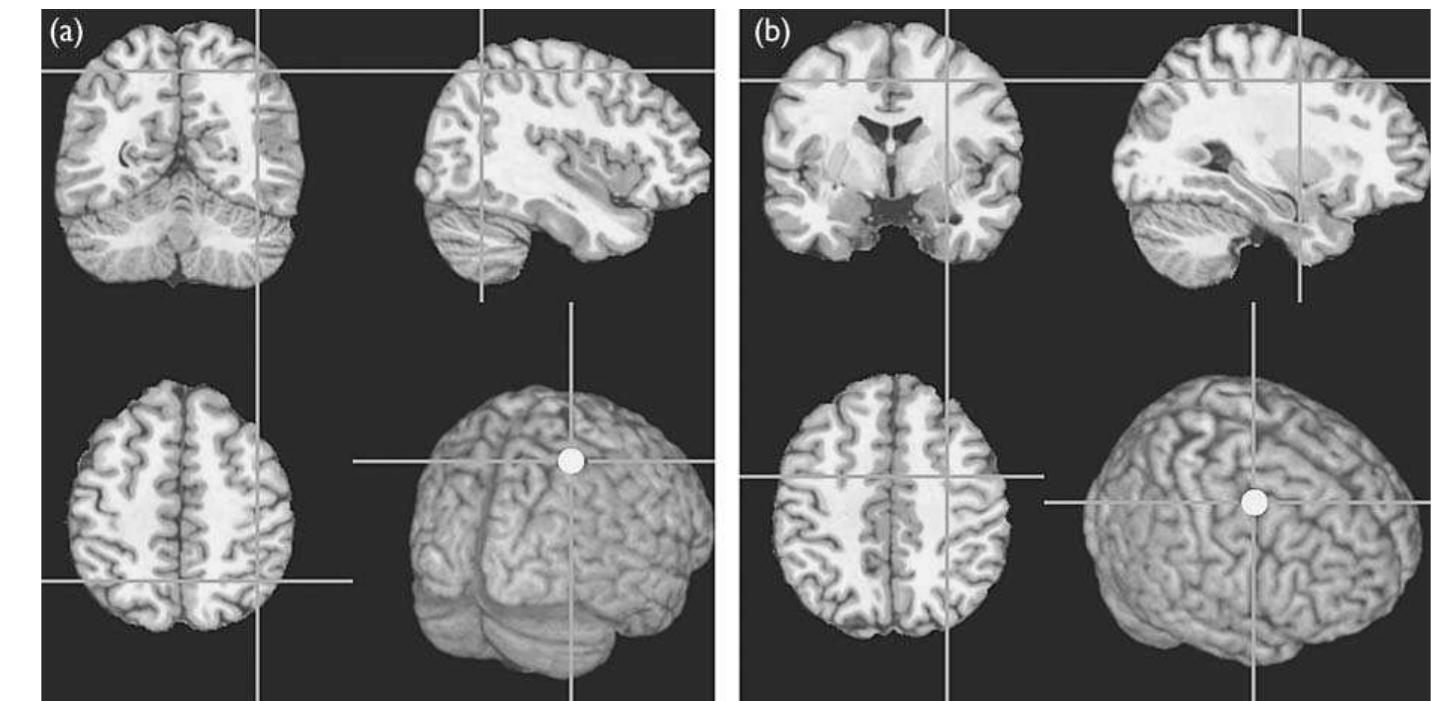 (PDF) The timing of the involvement of the frontal eye fields and ...