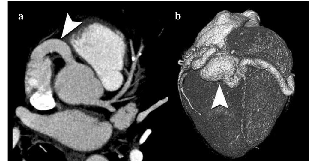 Multiplanar Volume Rendering Figure 4 - from Anomalie delle arterie coronarie: incidenza,