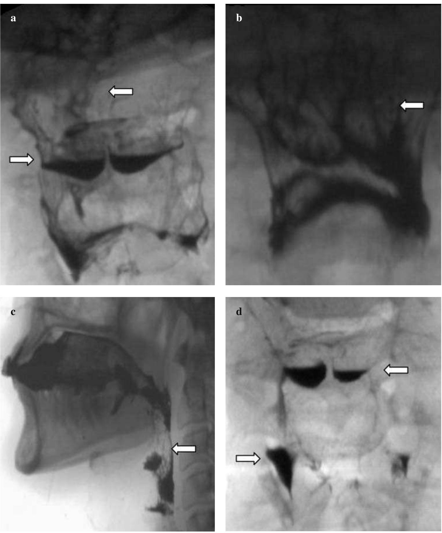 Contrast Pooling A,b intraswallowing laryngeal penetration (arrow) (a);