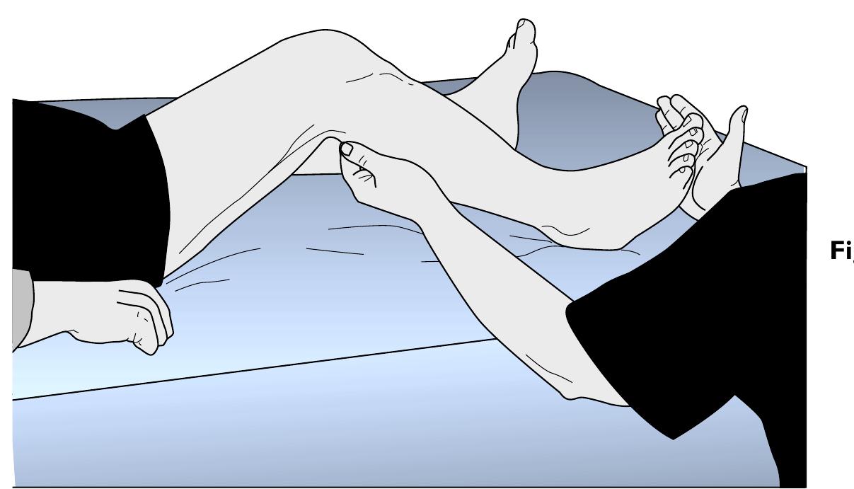 Figure 1 - from Homans' Sign in the Diagnosis of Deep Venous