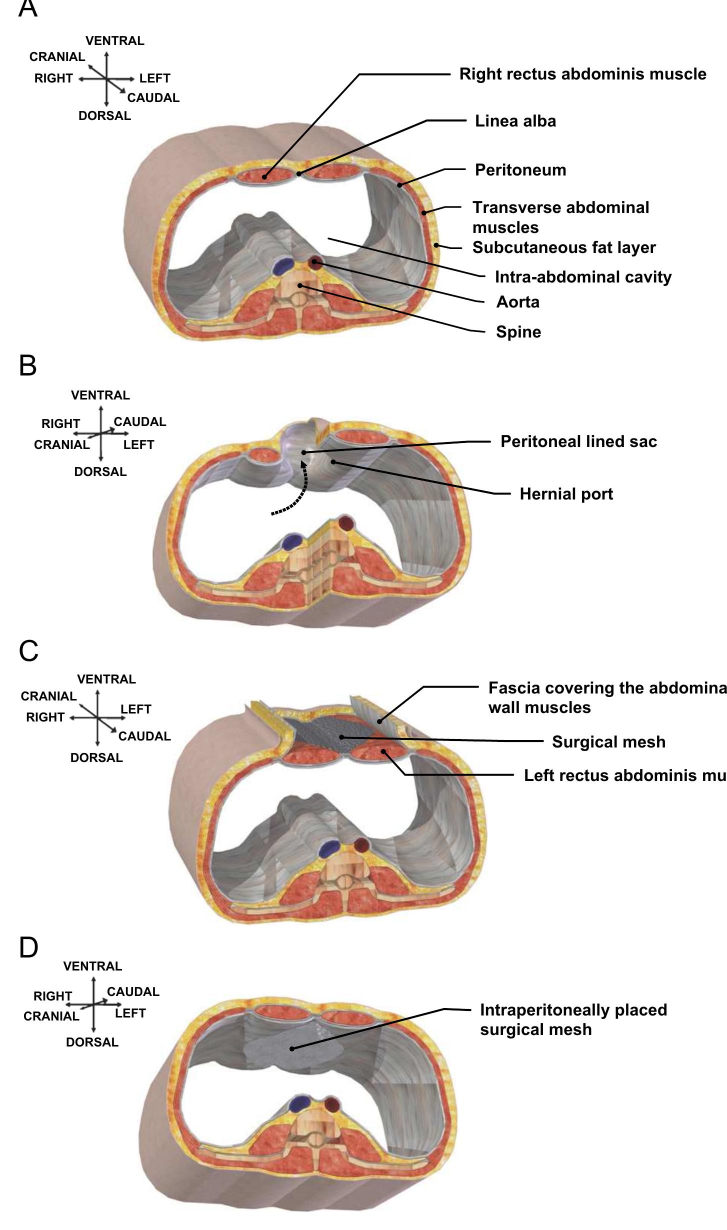 (PDF) The phenomenon of infection with abdominal wall reconstruction