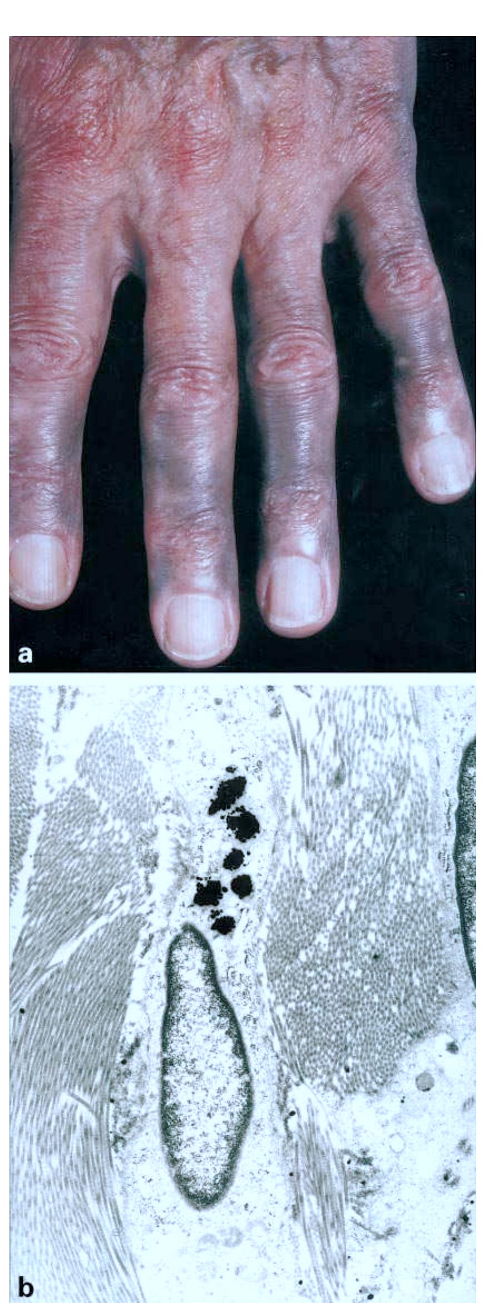 Pili Skin Rash (PDF) Cutaneous pili migrans