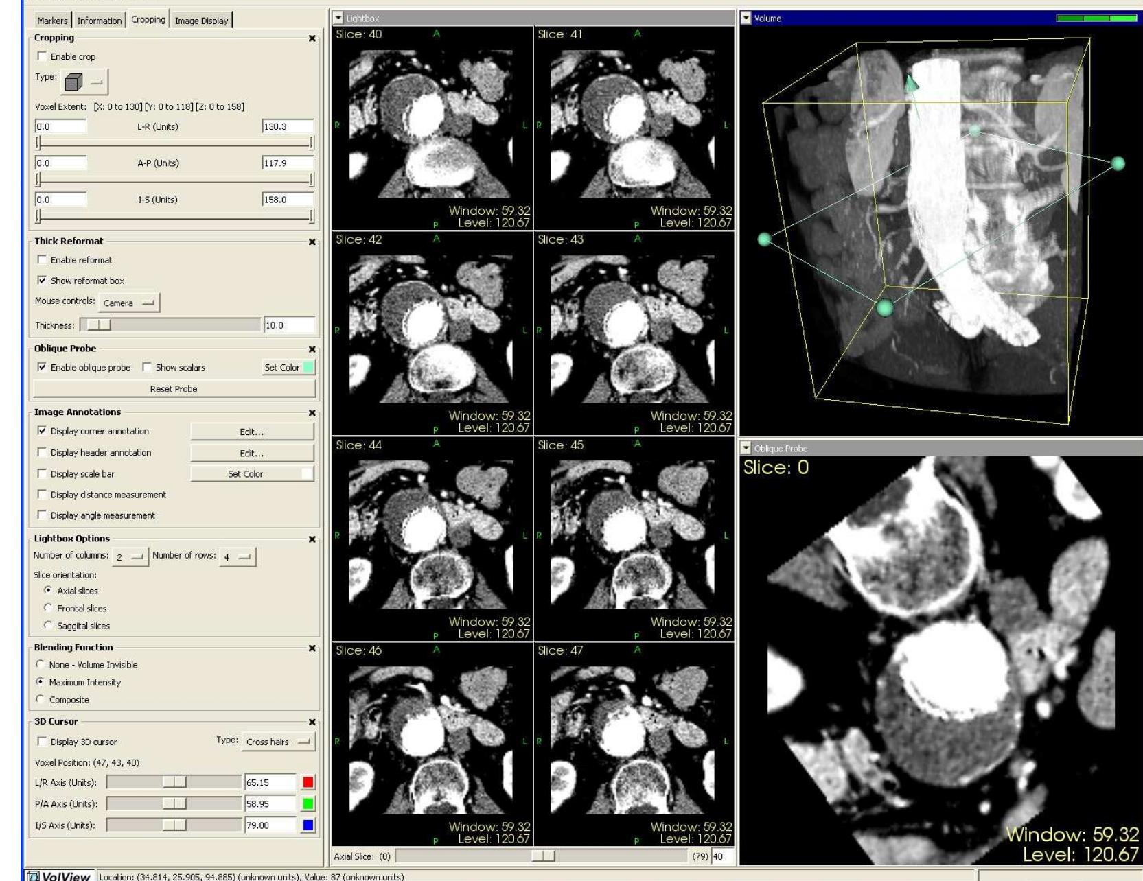 Procedure used for segmenting the abdominal aorta and the
