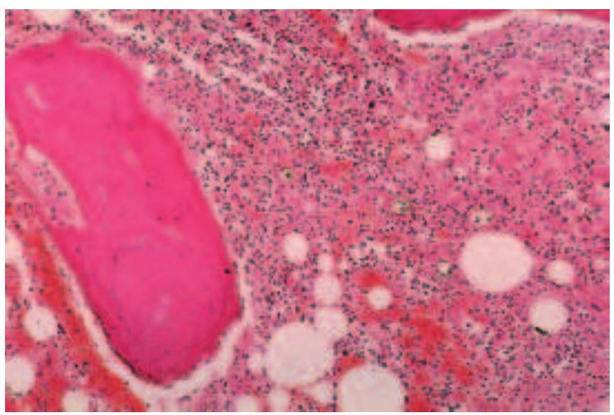 Plate 1 sickle cell crisis with bone infarction; the