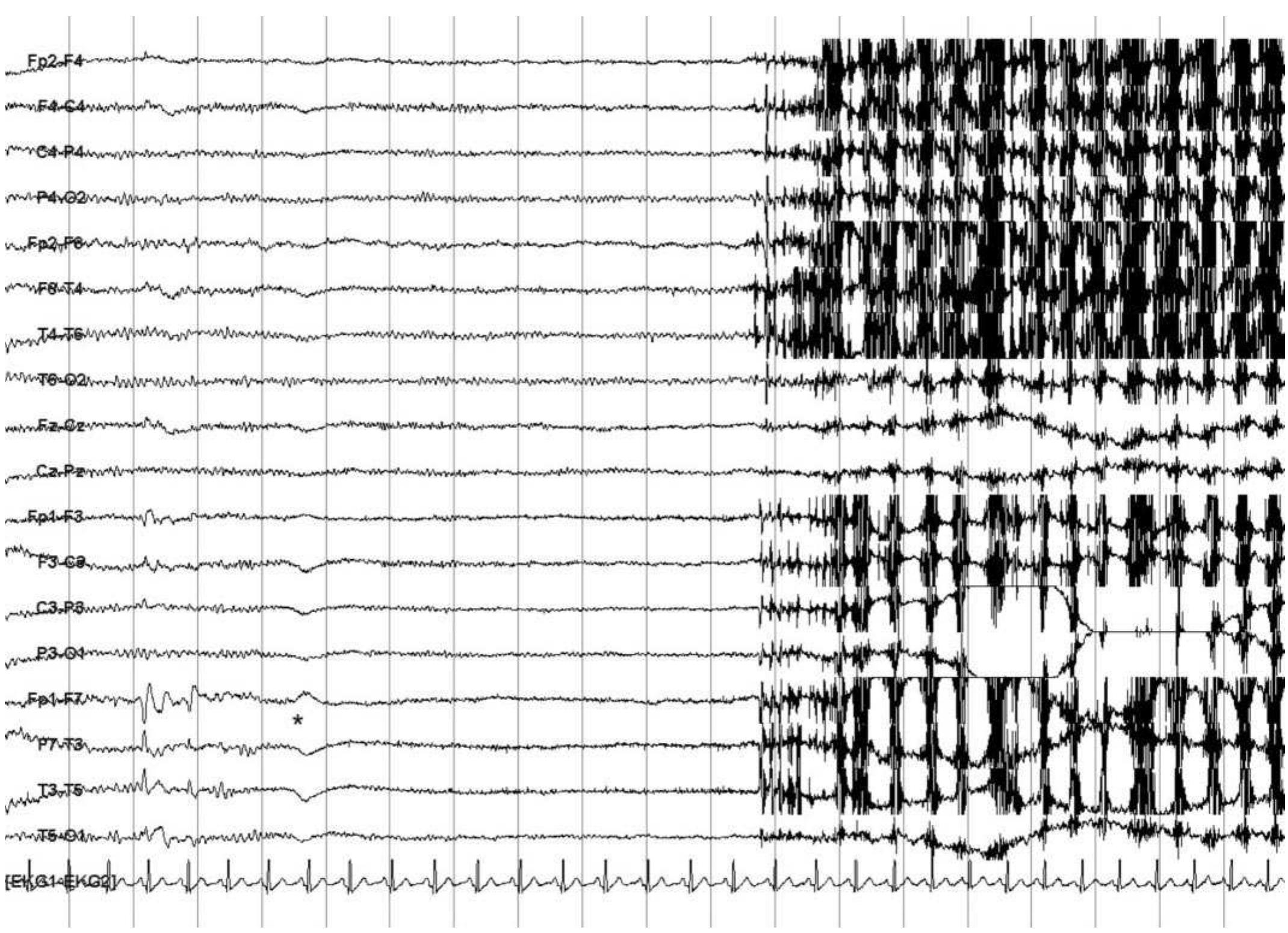 The Shocking Truth About Xl Spikes On Your Eeg - h5erctw