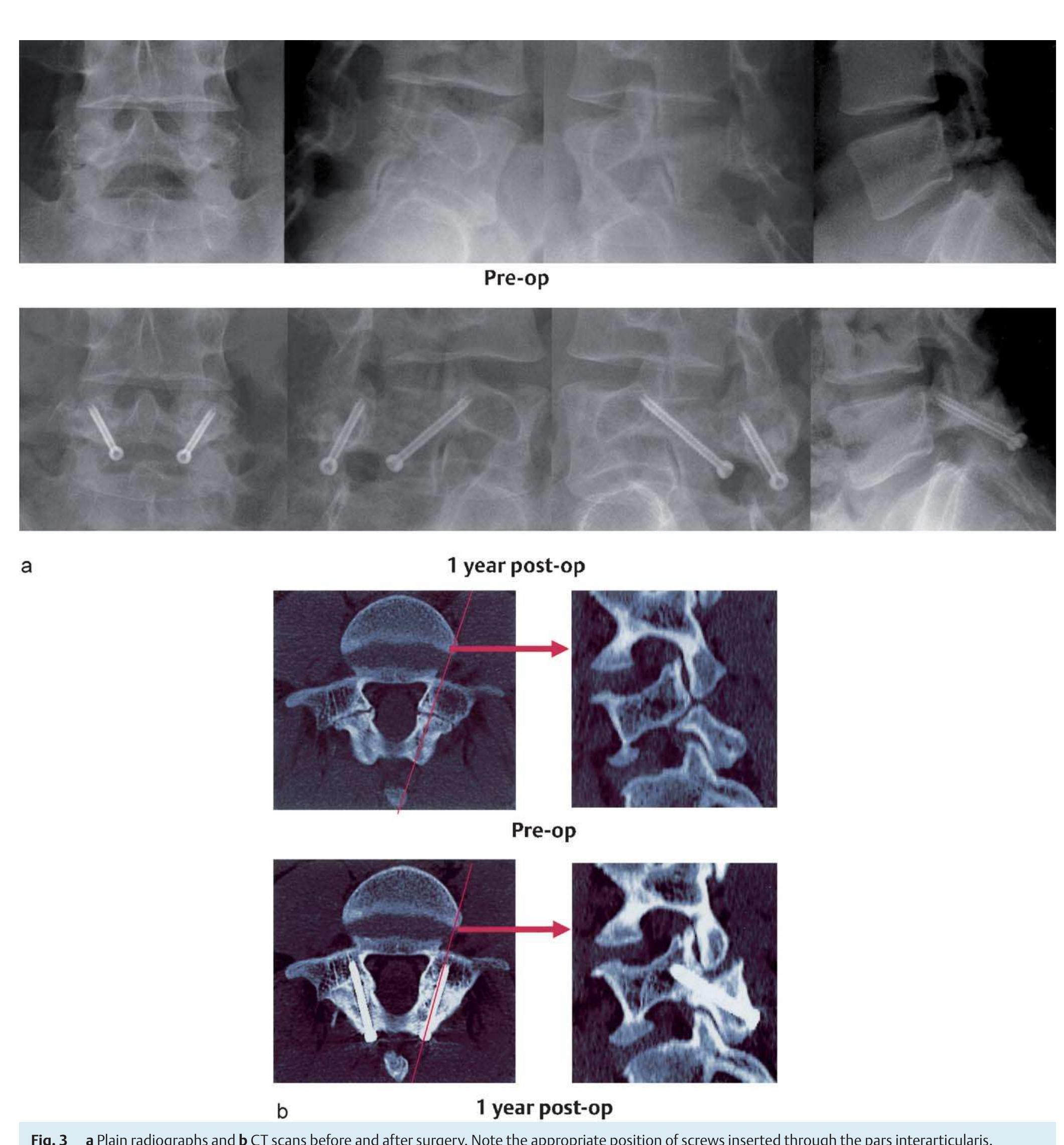 Pars Defect Block (PDF) Minimally Invasive Technique for Direct Repair of the Pars Defects
