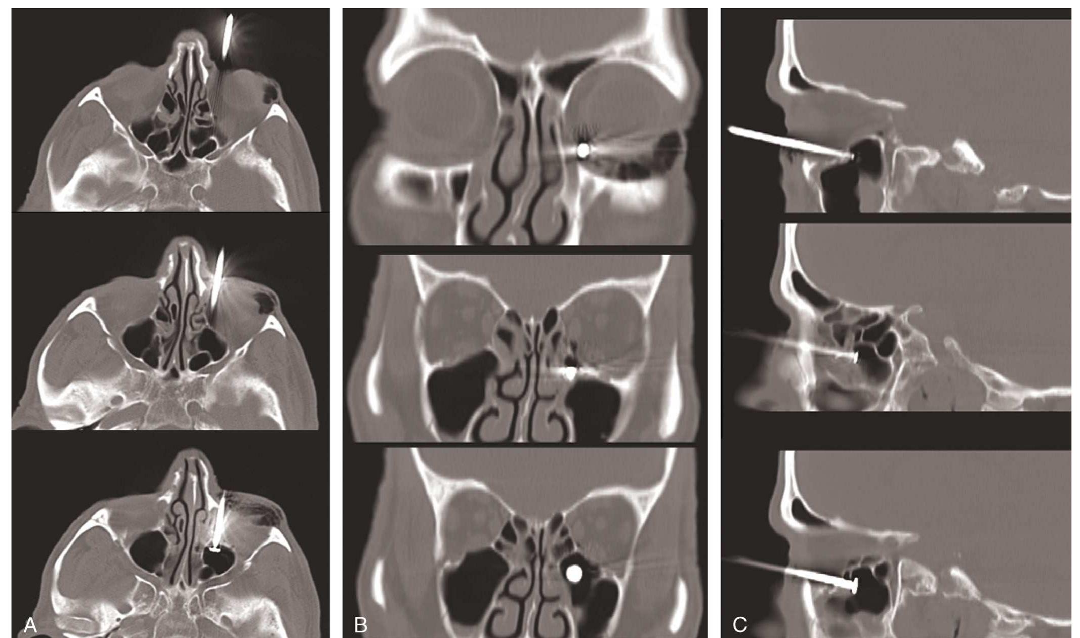 Figure 1 - from Penetrating Maxillary Sinus Injury Caused by