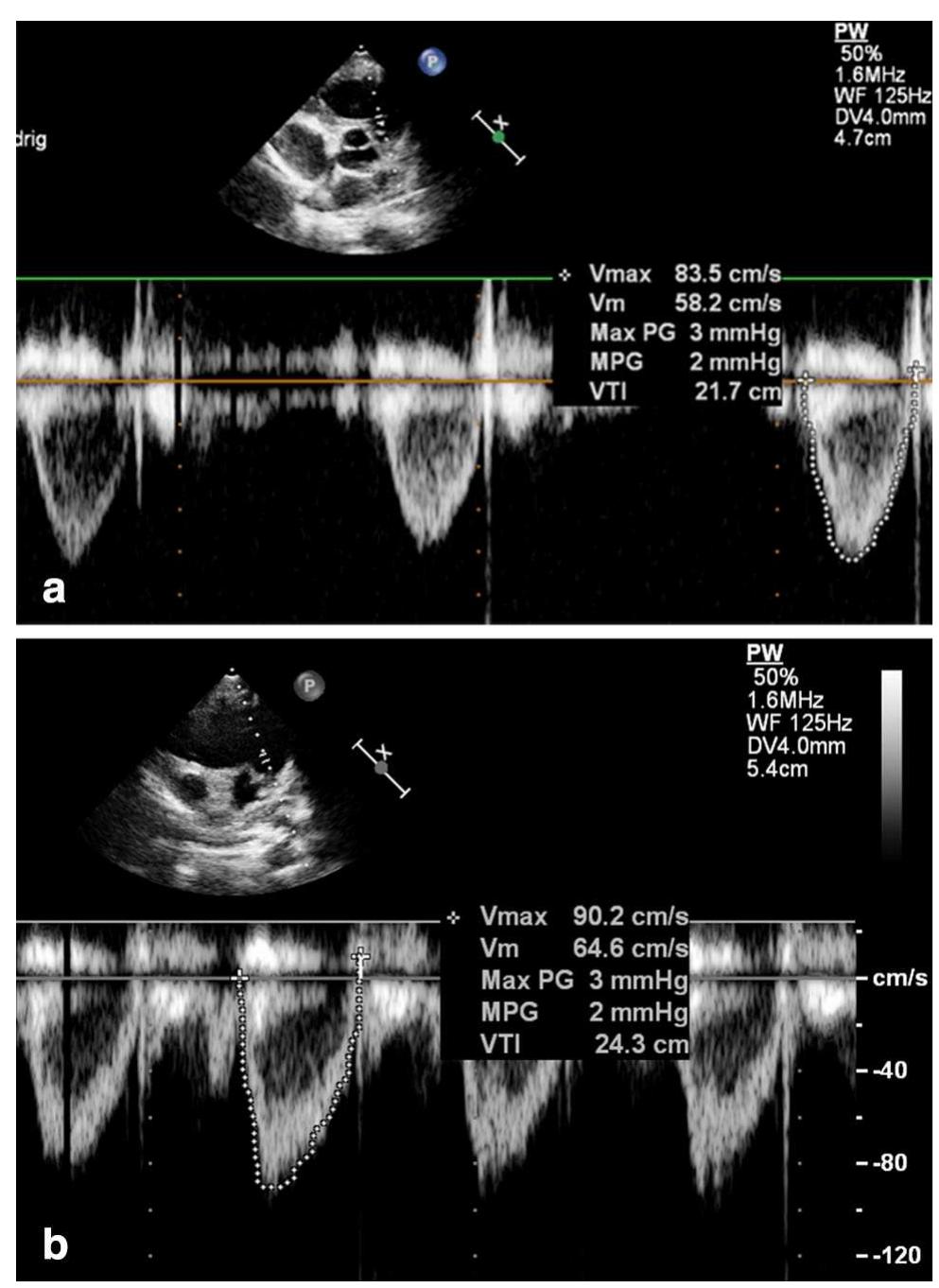 (PDF) Right Ventricular Outflow Tract Velocity Time Integral ...