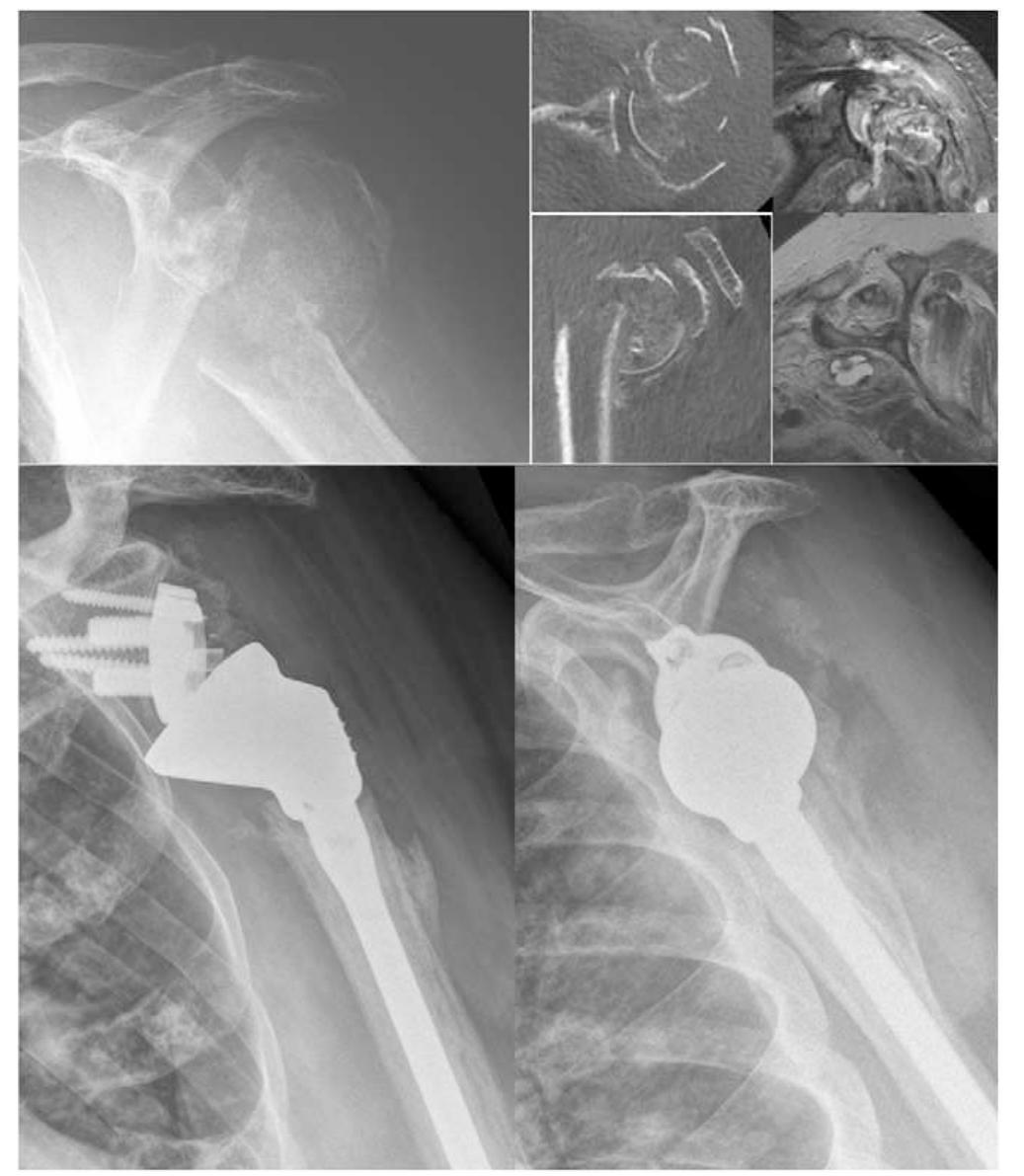 (PDF) Proximal Humeral Fracture Treatment in Adults