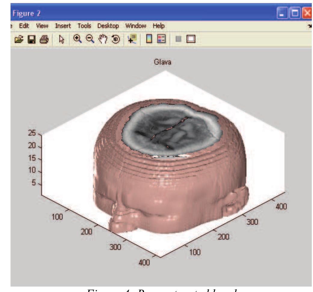 Mri Visualization Figure 3 - 3D visualisation of MRI images using MATLAB