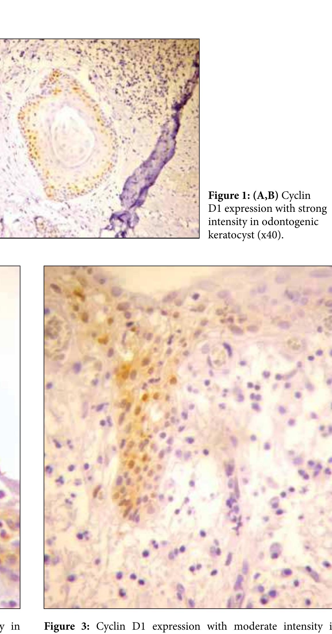 Cysts Expression Figure 3 - Cyclin d1 expression in odontogenic cysts