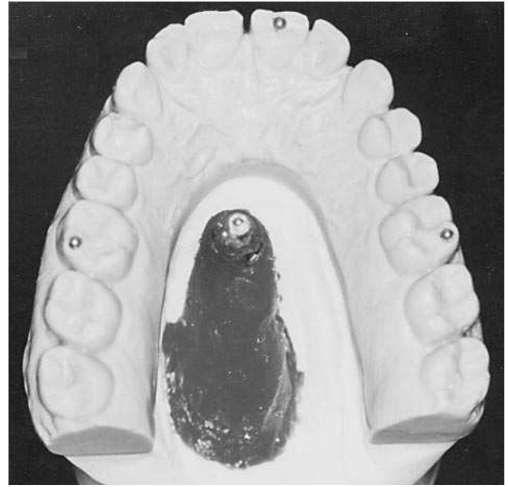 Maxillary cast with 3 reference points on maxillary right