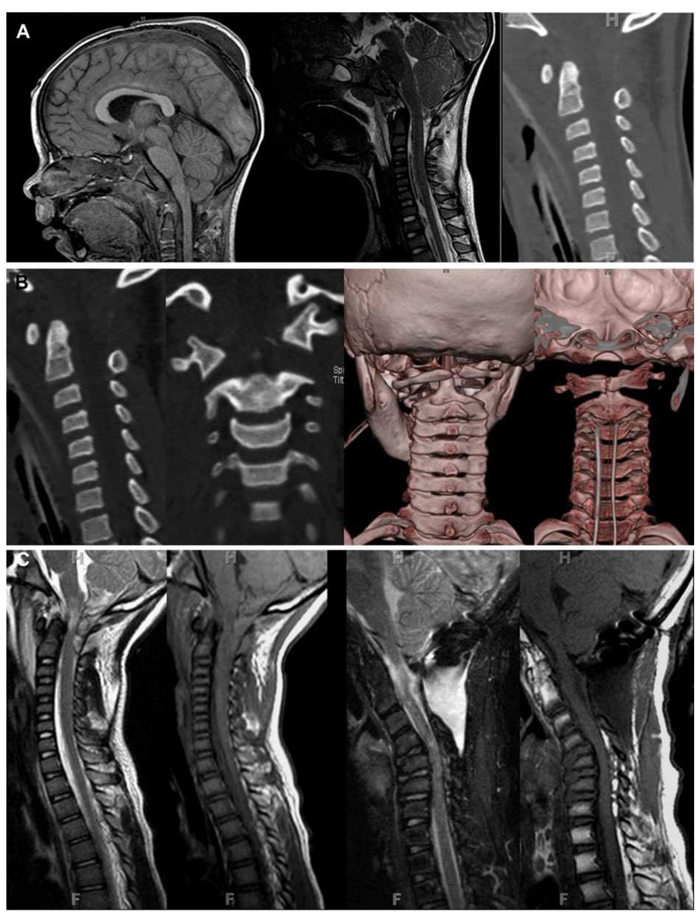 (a) sagittal t1 and t2-weighted mri and matching sagittal ct