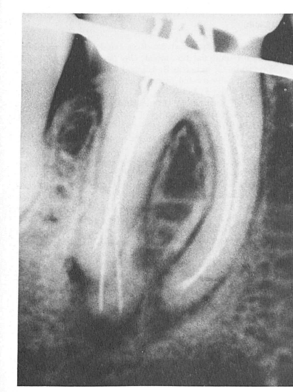 Vooth (PDF) Five root canals in a mandibular first molar