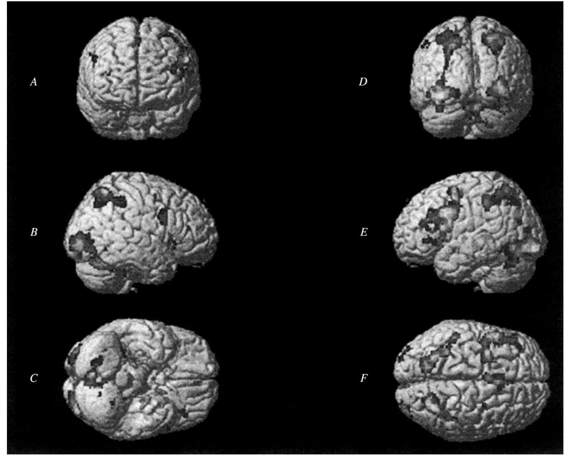 Group activation maps in healthy volunteers for the contrast