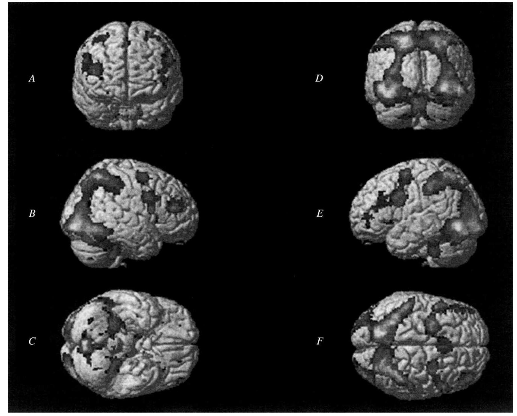 Group activation maps in healthy volunteers for the contrast