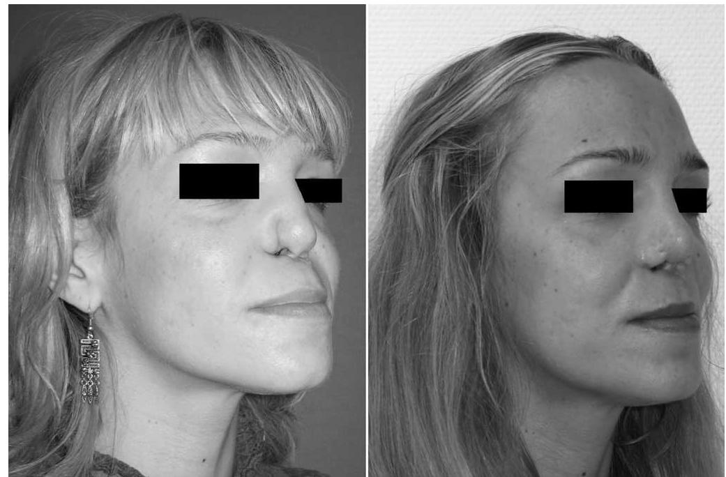 Lower Helical Rim Reconstruction (PDF) Bilateral Nasal Ala Reconstruction of the Cocaine-Injured Nose ...