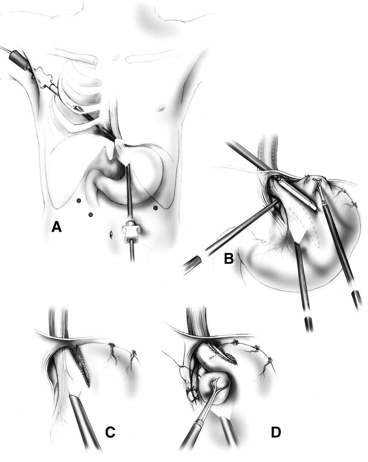 (PDF) The Short Esophagus: Pathophysiology, Incidence, Presentation ...