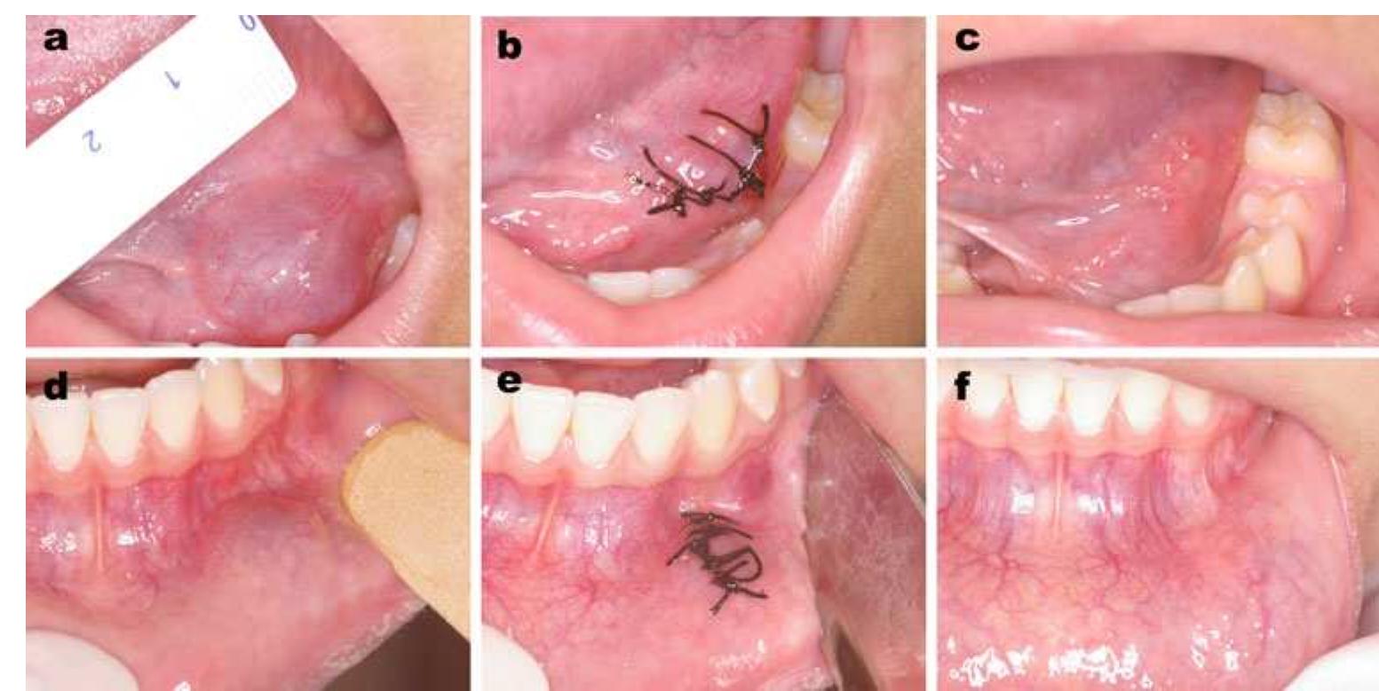 Marsupialization Small Ranula (PDF) Low level laser effect after micro-marsupialization technique in ...