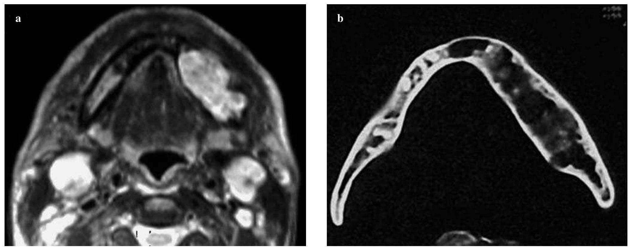 Axial t2-weighted magnetic resonance imaging (mri) scan at