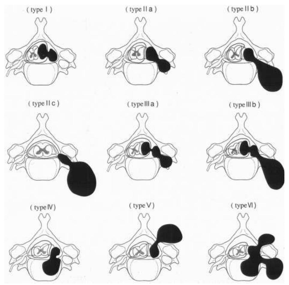 Figure 3 - from Surgical Approaches to Spinal Schwannomas