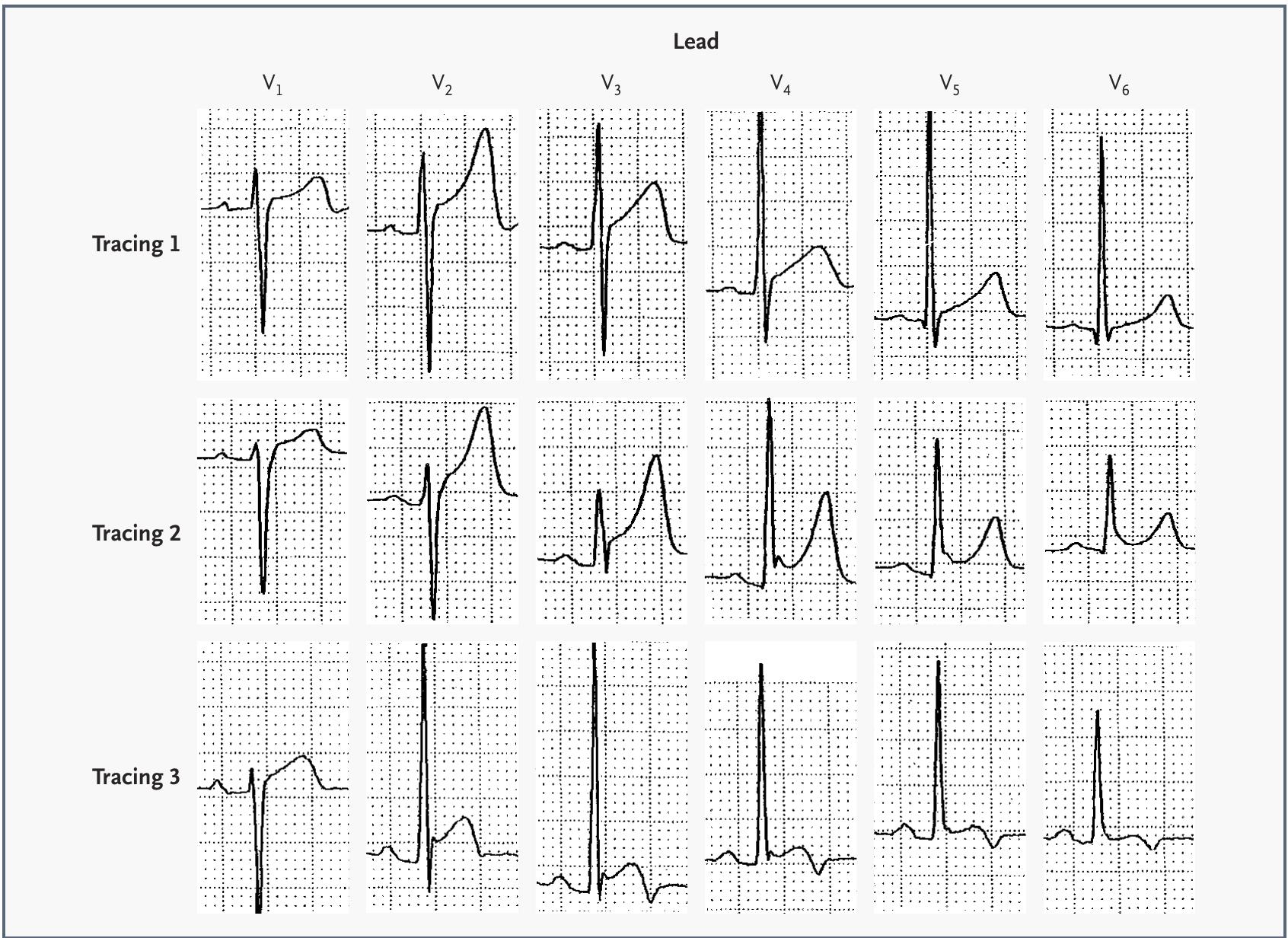 Electrocardiograms showing normal st-segment elevation and