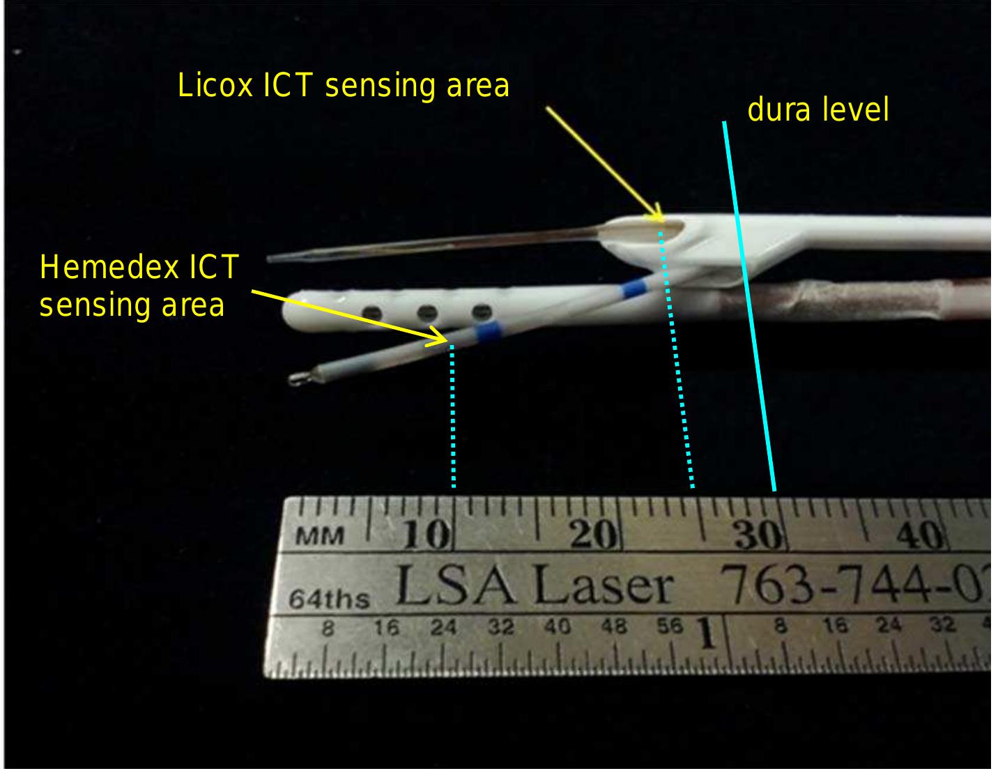Licox (PDF) Differences in Intracranial Temperature Measurements – A ...