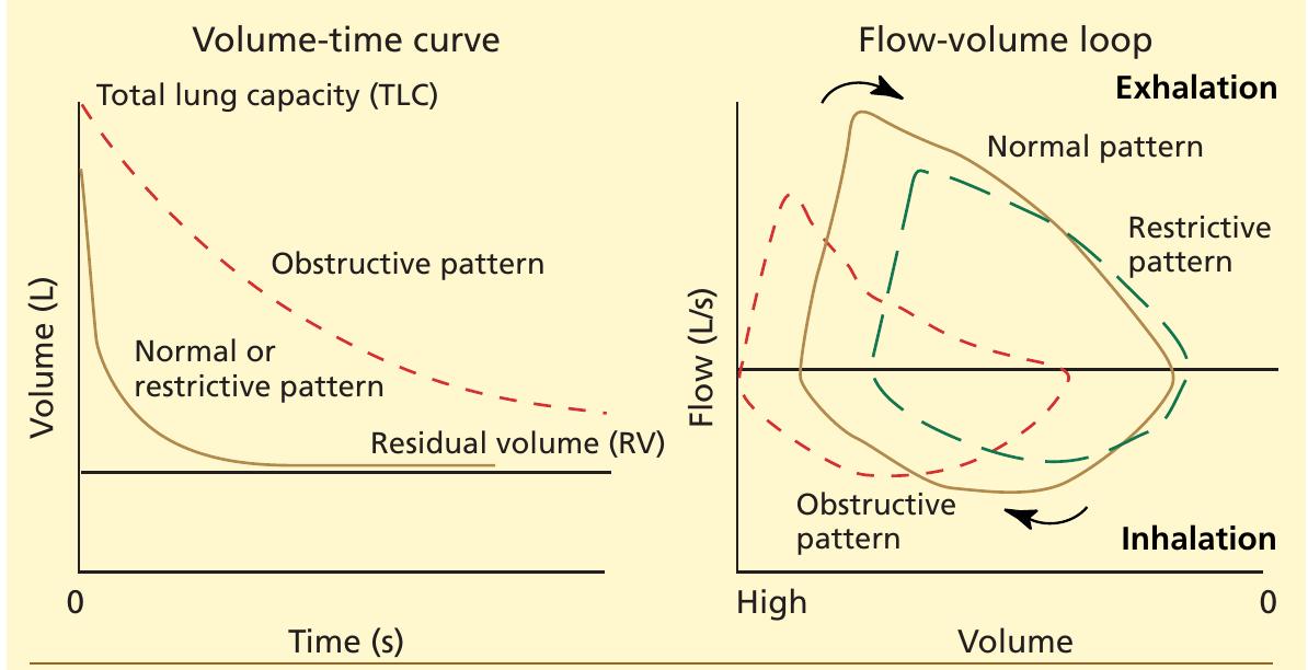 (PDF) Interpreting pulmonary function tests: recognize the pattern, and ...