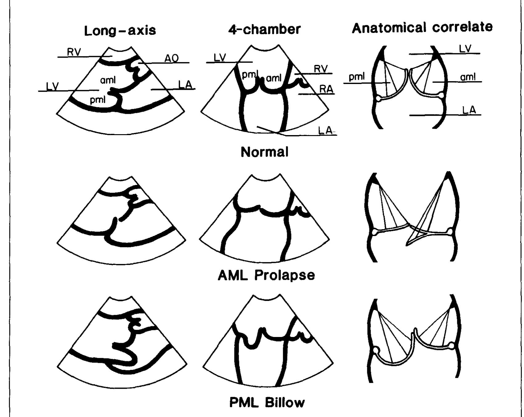 Figure 4 - from Functional anatomy of severe mitral