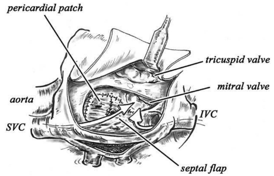 Senning Wrapper Figure 4 - from In the Footsteps of Senning: Lessons Learned