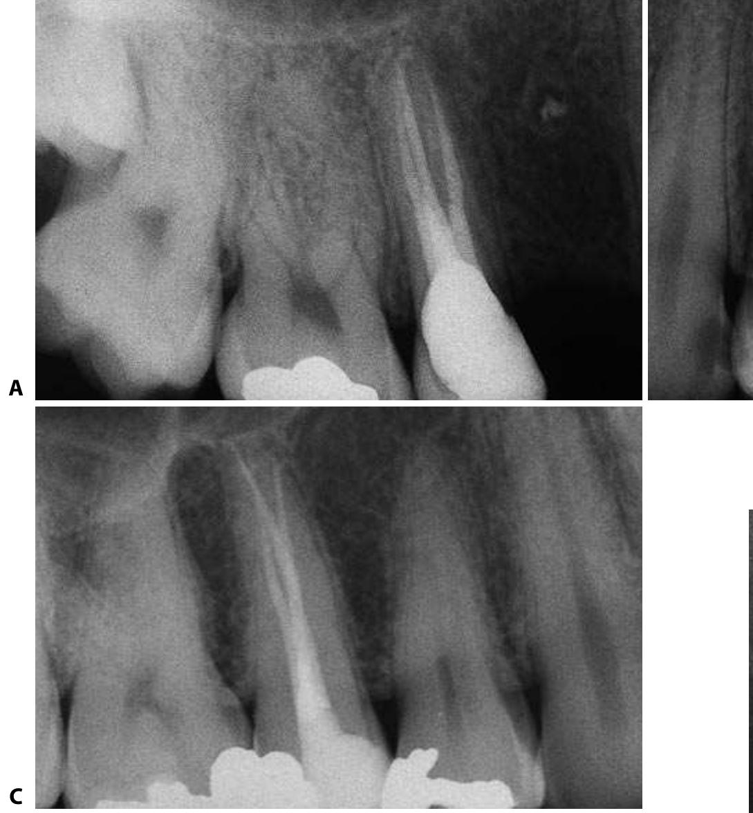 Premolar Roots Radiograph Figure 52 - from Endo- Castelluci.PDF