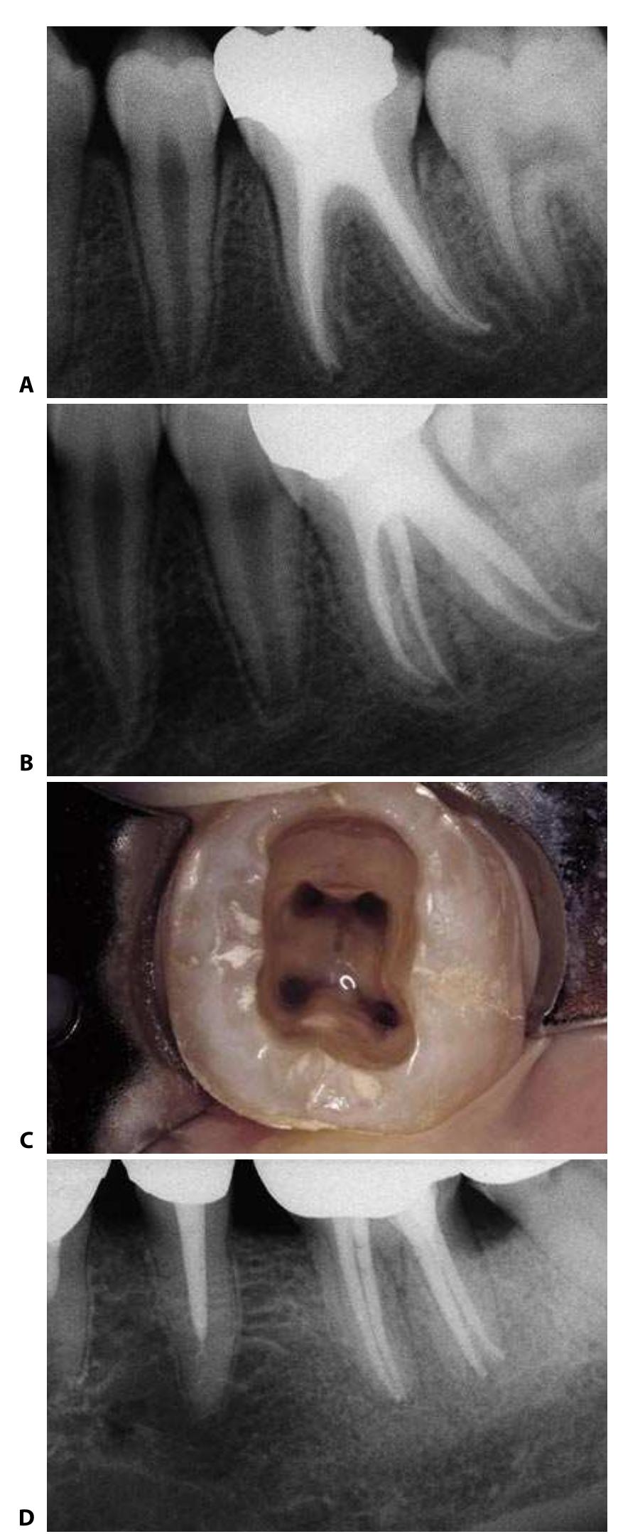 Stout Roots Radiograph 109. a. postoperative radiograph of the lower first molar.