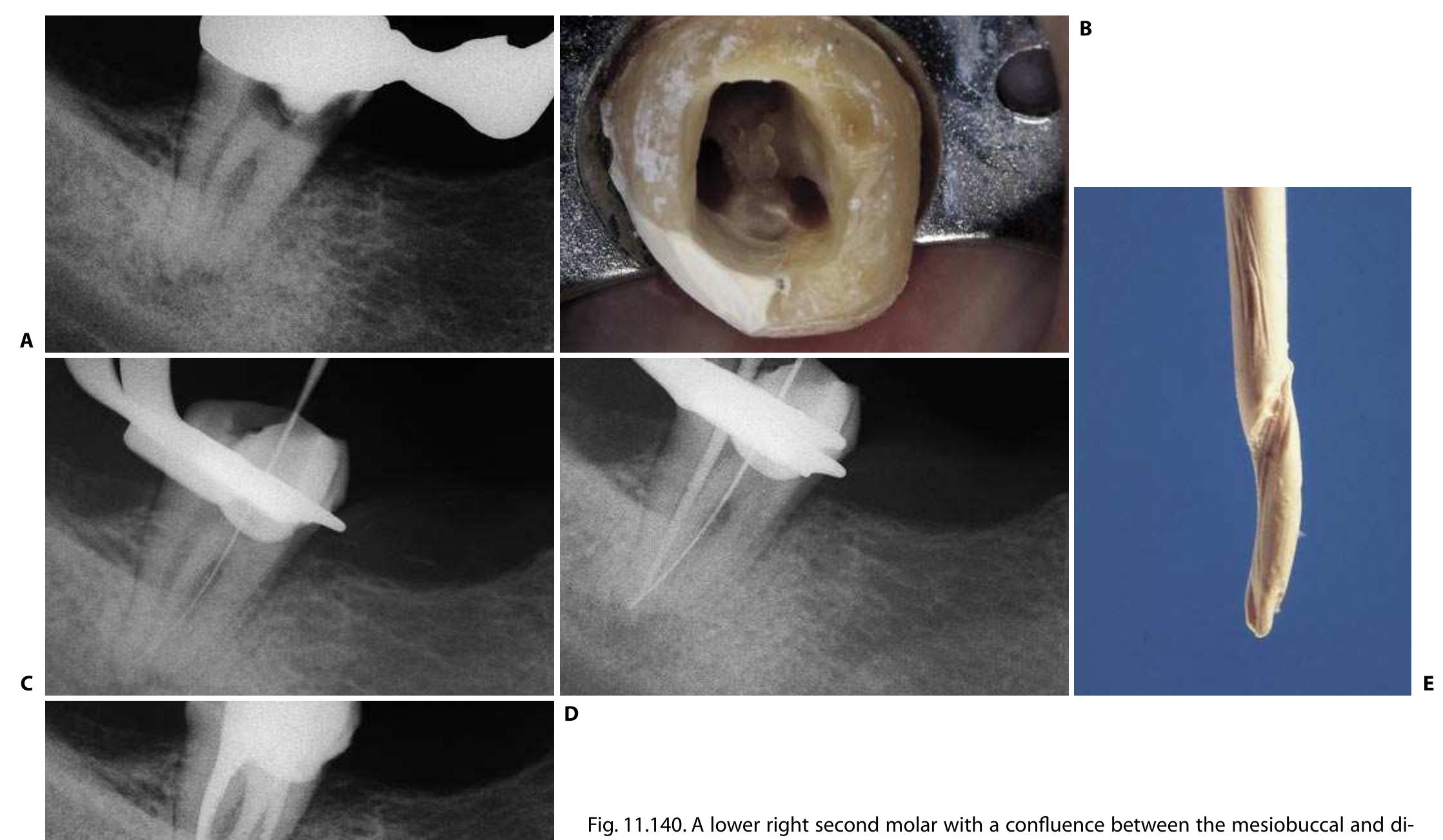 The access cavity of this tooth is started from the cen-