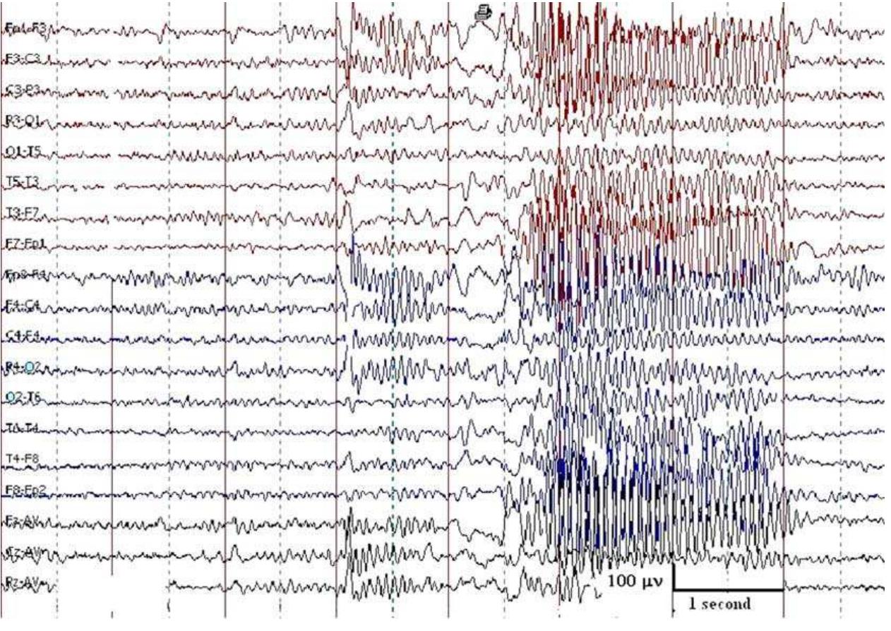 Random Spikes Figure 5 - Atypical EEG findings in subacute sclerosing