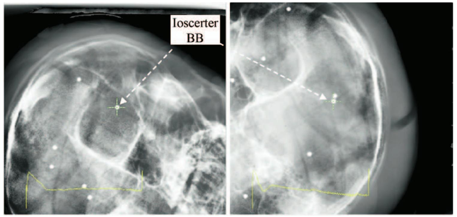 Isocenter Localization (PDF) Use of the BrainLAB ExacTrac X-Ray 6D system in image-guided ...
