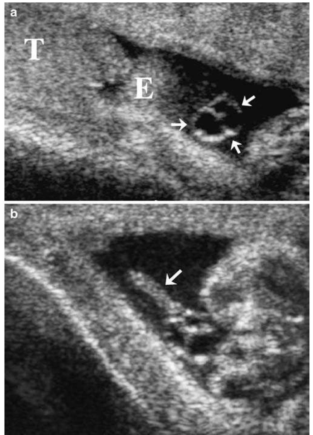 (PDF) Cystic appendix epididymis: a sonomorphologic study