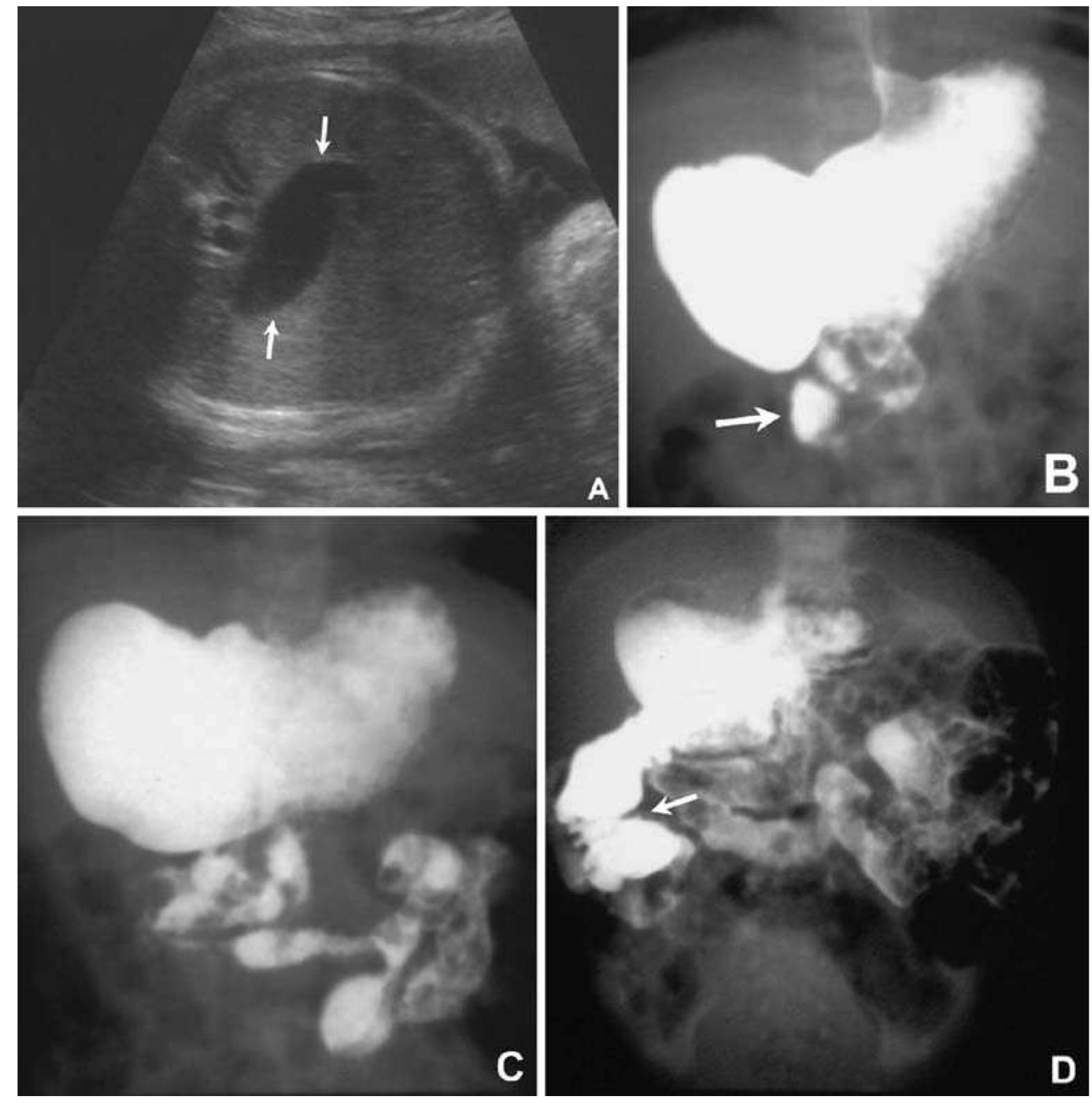 Fetal Intestinal Rotation (PDF) Sonographic prenatal diagnosis of malpositioned stomach as a ...