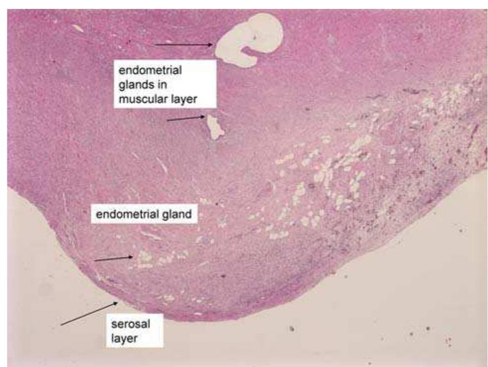 (PDF) Appendiceal endometriosis presenting as perforated appendicitis ...