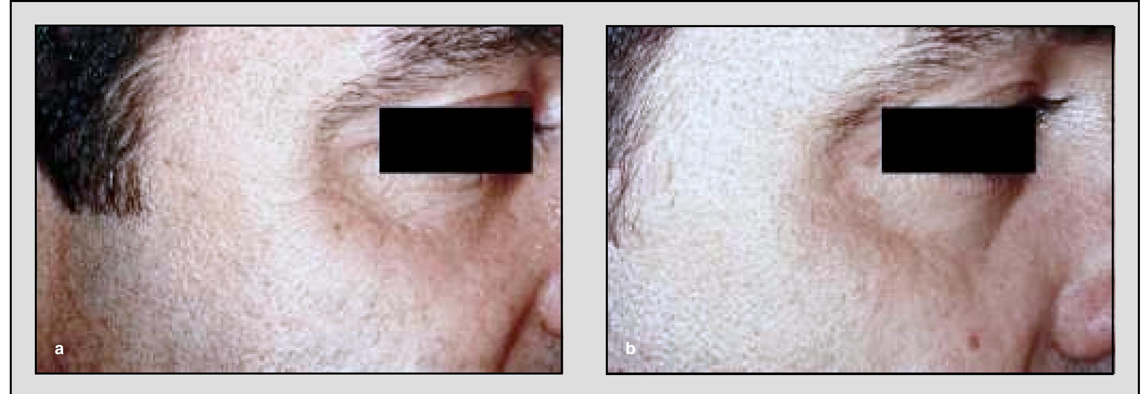 Periorbital rhytides before (a) and 6 months after (b) 3